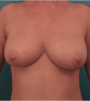 Breast Augmentation (Fat) Patient #1 After Photo Thumbnail # 2