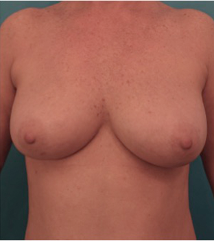 Breast Augmentation (Fat) Patient #1 After Photo # 2