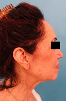 Facelift Patient #3 Before Photo # 5