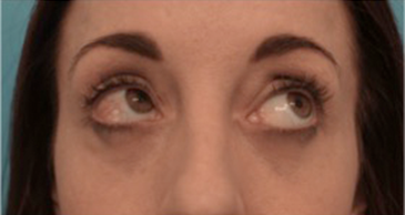 Lower Eyelid Blepharoplasty Patient #2 After Photo Thumbnail # 8