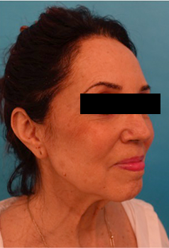 Facelift Patient #3 Before Photo # 3