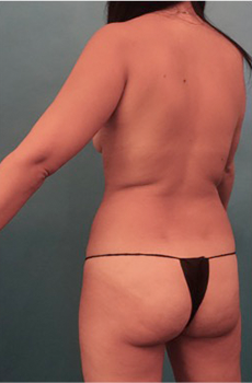 Brazilian Butt Lift Patient #7 Before Photo # 3