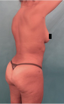 Brazilian Butt Lift Patient #6 After Photo # 10