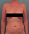 Liposuction Patient #21 Before Photo Thumbnail # 1