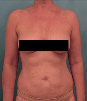 Liposuction Patient #21 Before Photo # 1
