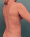 Liposuction Patient #21 After Photo Thumbnail # 12