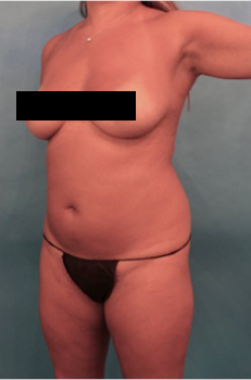 Brazilian Butt Lift Patient #6 Before Photo # 5