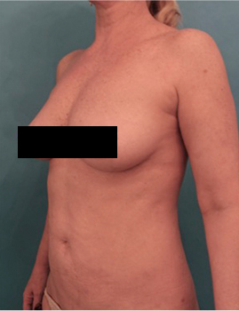 Liposuction Patient #21 After Photo # 4