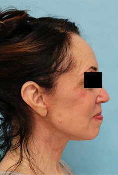 Facelift Patient #3 After Photo # 6