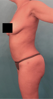 Brazilian Butt Lift Patient #6 After Photo Thumbnail # 2