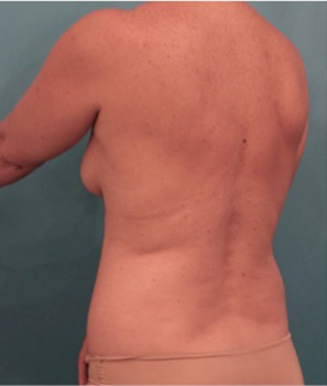 Liposuction Patient #21 Before Photo # 7