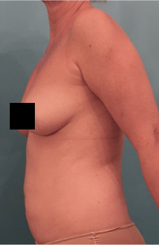 Liposuction Patient #21 Before Photo # 5