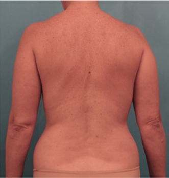 Liposuction Patient #21 Before Photo # 9