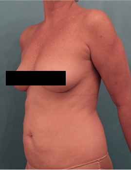 Liposuction Patient #21 Before Photo # 3