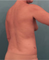 Liposuction Patient #21 Before Photo Thumbnail # 11