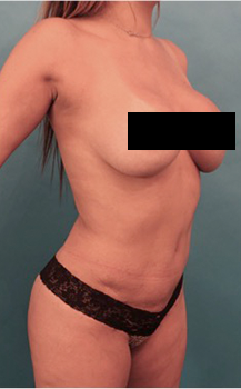 Brazilian Butt Lift Patient #5 After Photo # 4