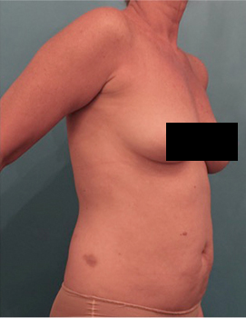 Liposuction Patient #21 Before Photo # 15