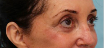 Lower Eyelid Blepharoplasty Patient #4 After Photo # 4