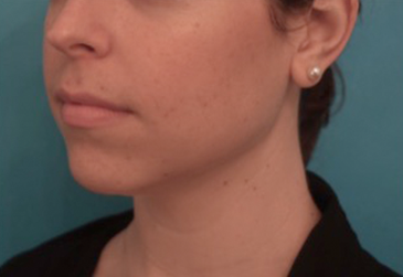 Kybella Patient #17 Before Photo # 3