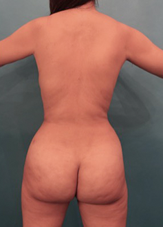 After Image: Liposuction Patient #24 - 