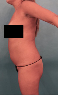 Liposuction Patient #22 Before Photo # 5