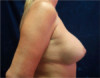 Breast Augmentation (Implants) Patient #17 After Photo Thumbnail # 6
