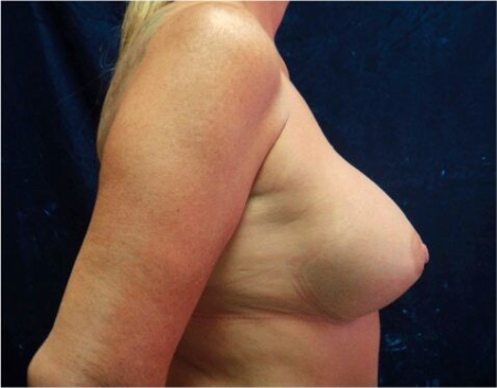 Breast Augmentation (Implants) Patient #17 After Photo # 6