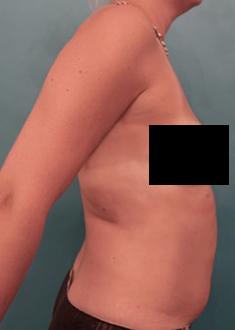 Before Image: Liposuction Patient #25 -