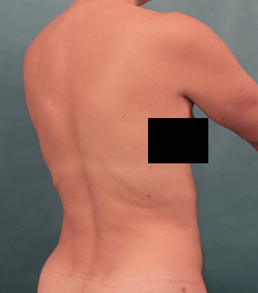 After Image: Liposuction Patient #25 -