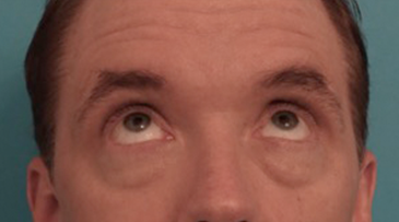 Male Blepharoplasty Patient #2 Before Photo # 3