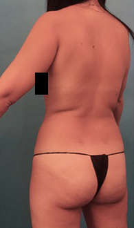 Before Image: Liposuction Patient #24 - 