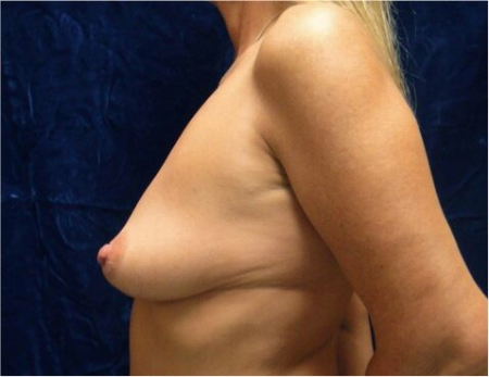Breast Augmentation (Implants) Patient #17 Before Photo # 9