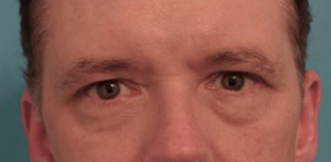 Male Blepharoplasty (Eyelid Lift) Patient