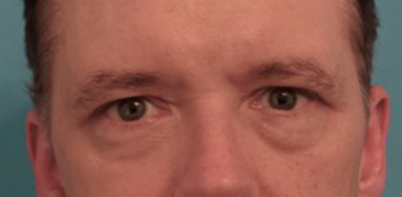 Male Blepharoplasty Patient #2 Before Photo # 1