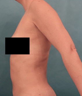Liposuction Patient #25 After Photo # 6