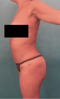 Liposuction Patient #22 After Photo # 6