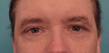 Male Blepharoplasty Patient #2 After Photo Thumbnail # 2