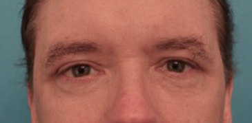 Male Blepharoplasty Patient #2 After Photo # 2