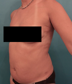 Liposuction Patient #25 Before Photo Thumbnail # 3