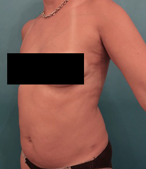 Before Image: Liposuction Patient #25 -