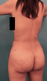 After Image: Liposuction Patient #24 - 