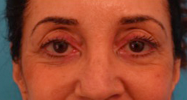 Lower Eyelid Blepharoplasty Patient #4 Before Photo # 1