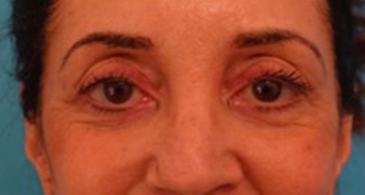 Blepharoplasty (Eyelid Lift) Patient