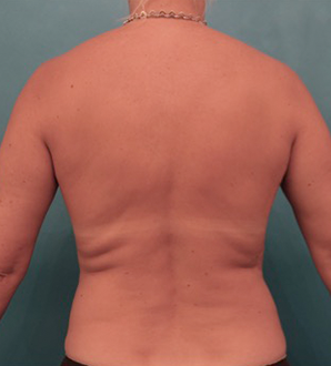 Before Image: Liposuction Patient #25 -