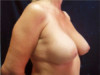Breast Augmentation (Implants) Patient #17 After Photo Thumbnail # 4
