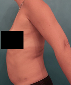 Before Image: Liposuction Patient #25 -