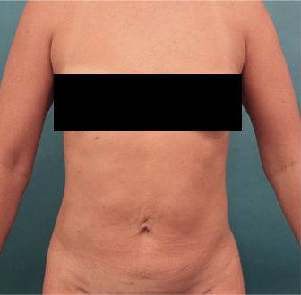 Liposuction Patient #25 After Photo Thumbnail # 2