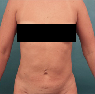 After Image: Liposuction Patient #25 - 