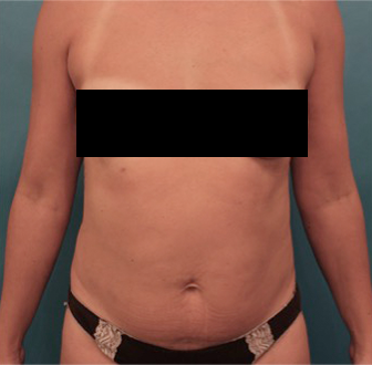 Before Image: Liposuction Patient #25 - 