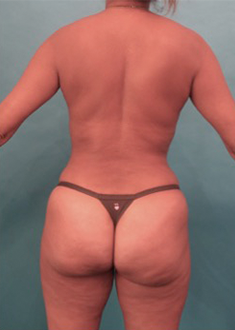 Liposuction Patient #22 After Photo # 10